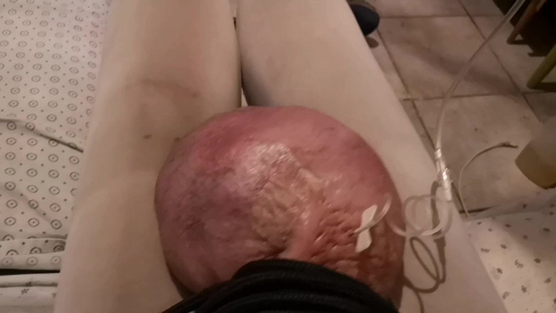 Monster_Meat_: Füllen mit 0,500liter Glucose 10%