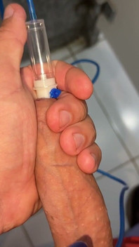 Sounding Extreme Sharp Probing in the Urethral Canal.