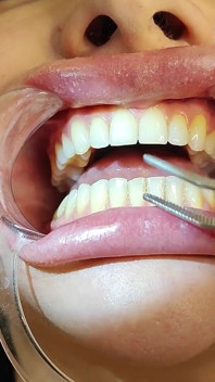 Pemeriksaan gigi yang lengkap oleh Doktor Gigi, Pemasangan Barang Kemas