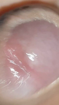Glans Eye Watering After Intense Fucking.