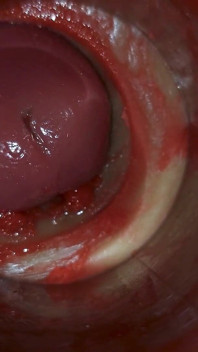 Camera Inside Deep Pussy Captures Huge Ejaculation of Sperm Asmr