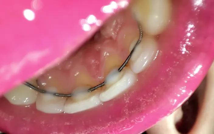 Princess18_: Permanent Retainers Mouth Tour
