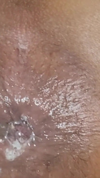Trying to Get the Sperm Out, It Was so Deep That It Didn't Come Out