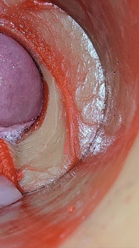 Female Insemination - внутренняя камера снимает глубокую мужскую огромную эякуляцию