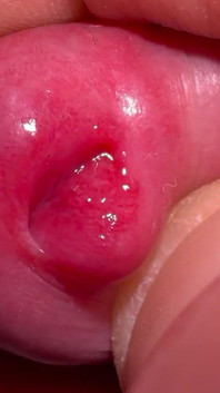 Macro Skin on My Dick