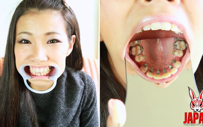 Japan Fetish Fusion: Ortopedi takıntısı: diş teli ile yolculuğum
