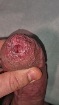 Close up on Phimosis Large Cock, so Hot!