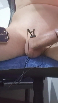 E-stim Hfo