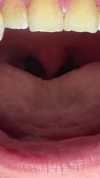 Mouth & Tonsils Close-up