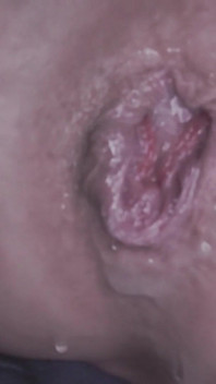 Anal Destruction