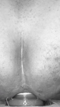 Sumbat Anal Ekstrem