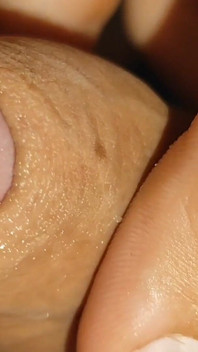 Difficult Fluid Control Due to Straight Phimosis.