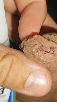 Super Glue, Gluing the Phimosis Leather on the Glans!