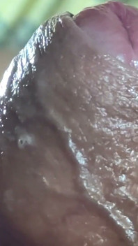 ¡fimosis Venosa Extrema En La Bomba!