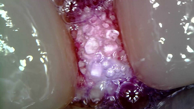 Nicoletta Embassi: Medical Endoscope Oral Exam: Gummy Chewing, Extreme Teeth &amp; Tongue Macro