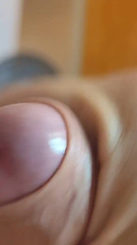 The Glans Appears Crowning Inside the Phimosis.