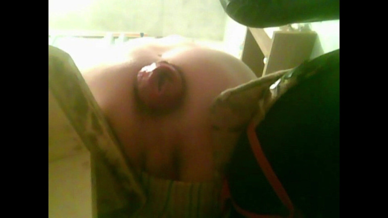 IncredibleGuy: Un chico joven está sentado en una silla con prolapso...