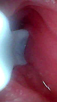 I Couldn’t Believe What Happens Inside the Penis as Sperm Passes Through (endoscopic Footage)