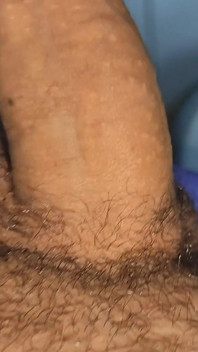 The Great Transformation of Phimosis Elastica.