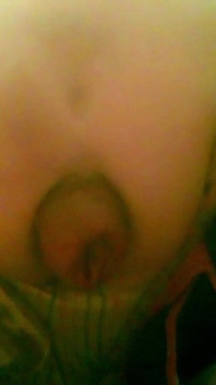 A Young Guy Is Sitting on a Chair with Anal Prolapse