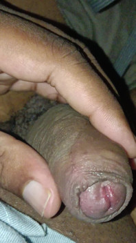 Urine Infection