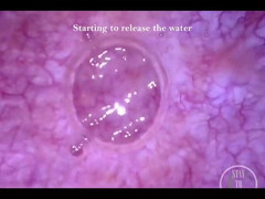 Lina Free: देखने का बिंदु एंडोस्कोप कैथेटर ब्लैडर मुद्रास्फीति!