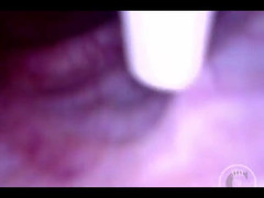 Lina Free: Pov nội soi ống thông lạm phát bàng quang!