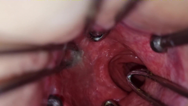 Giantasshole: Mega anální roztahování a hluboký pohled do mého zadku