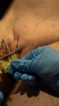 107 Needles CBT