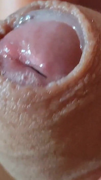 Deep Split in the Glans Produces Bubbling Liquid
