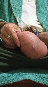 Saline in the Testicles