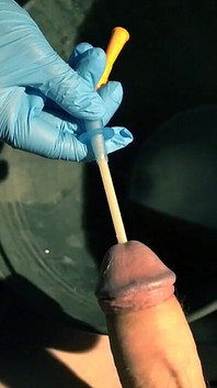 Bakış açısı hasta. Bir Sonda Sesi Çıkarıyor ve Yerleştiriyor