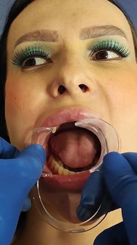 Complete Teeth Exam by the Dentist, Installation of Jewelry