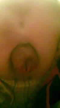 A Young Guy Is Sitting on a Chair with Anal Prolapse