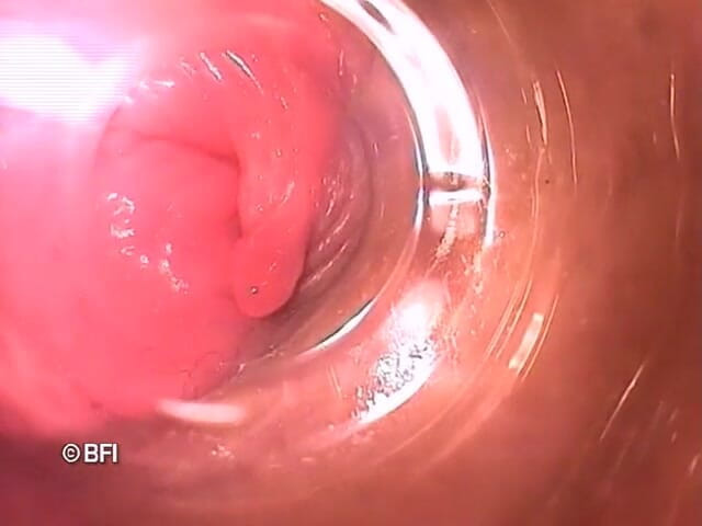 Pegging insertion: 奇怪的文件 162