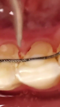 Limpando dentes com escova de dentes, irrigador, gancho dental