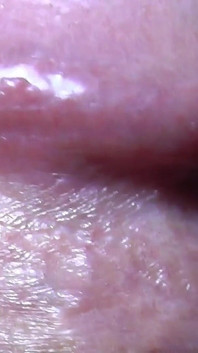Tayson's glands or pearly papules