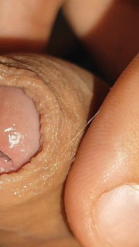 Difficult Fluid Control Due to Straight Phimosis.