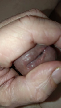 Is My Meatus Open?