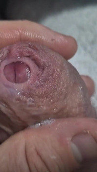 언컷 꽉 조이는 Phimosis 자지 포피 클로즈업