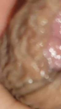 Boy with Large Anal Phimosis Excited!