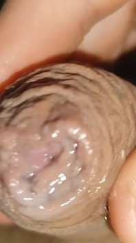 Écume Du Plus Grand Prépuce De Phimosis Au Monde.