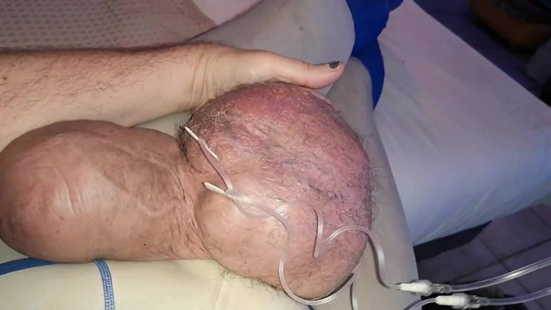 Monster_Meat_: Tampalan berganda glukosa 2liter