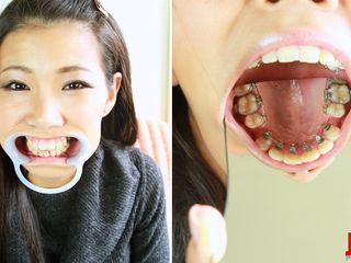 Japan Fetish Fusion: Ortho Obsession：我用牙箍的旅程