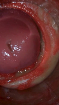 Camera Inside Deep Pussy Captures Huge Ejaculation of Sperm Asmr