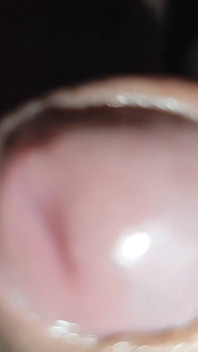 Young Man with Phimosis Opening the Glans