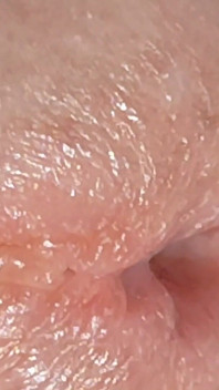 Enlargement of the Deep Urethral Hole!!