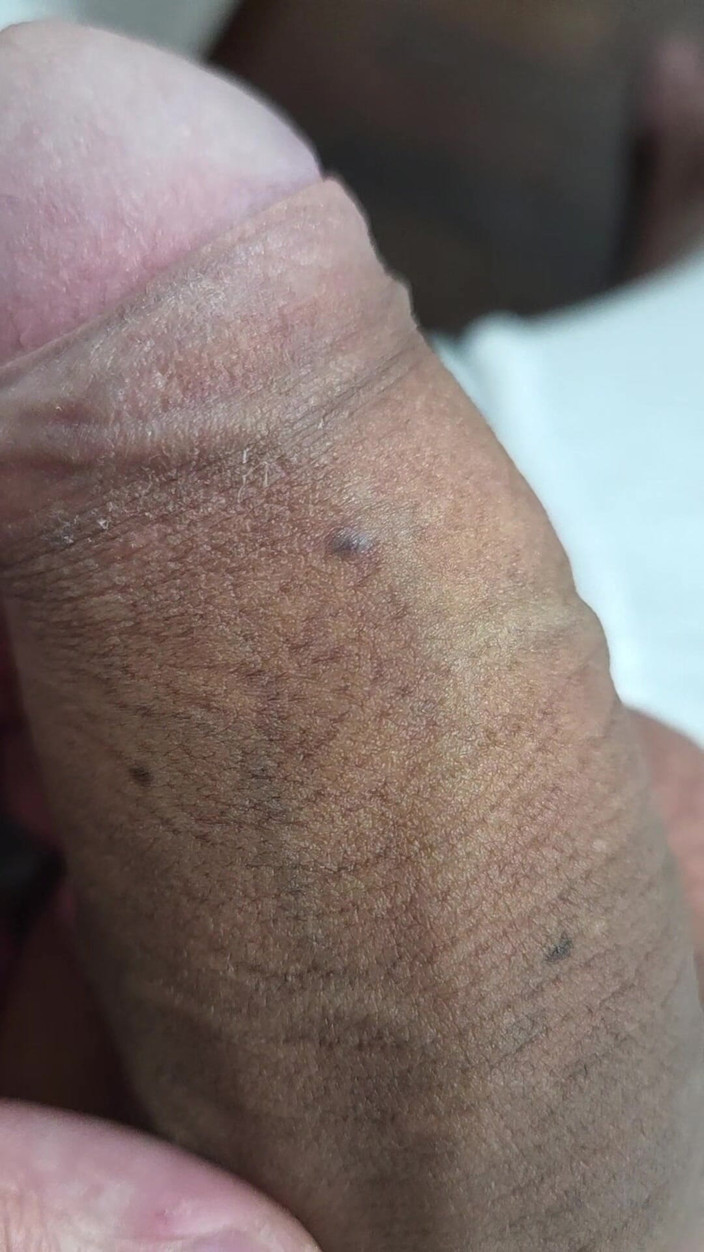 Lkdick8: Quelles sont ces taches sur mon pénis