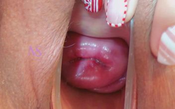 Cervix Uterine