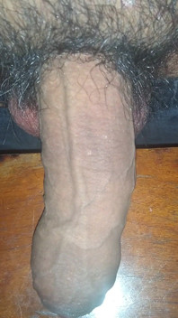 Ereksi langsung